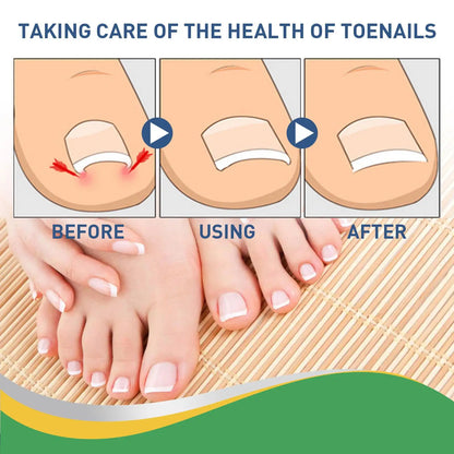 Painless Nail Fungus Therapeutic Instrument Laser Foot Care